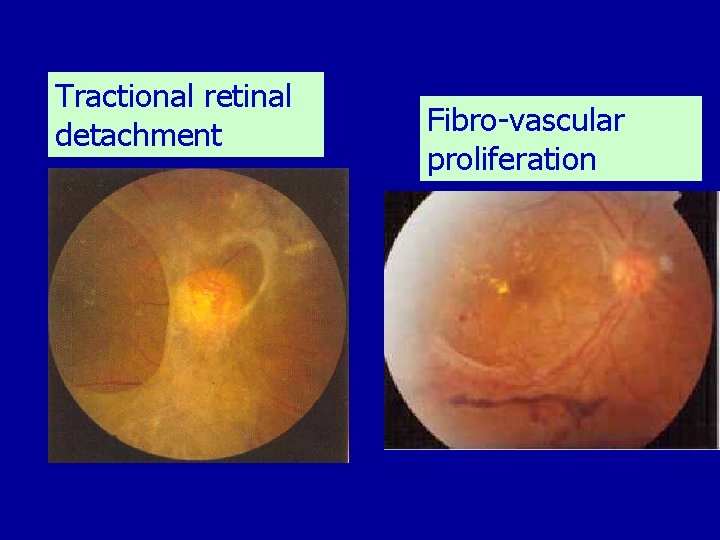 Tractional retinal detachment Fibro-vascular proliferation 