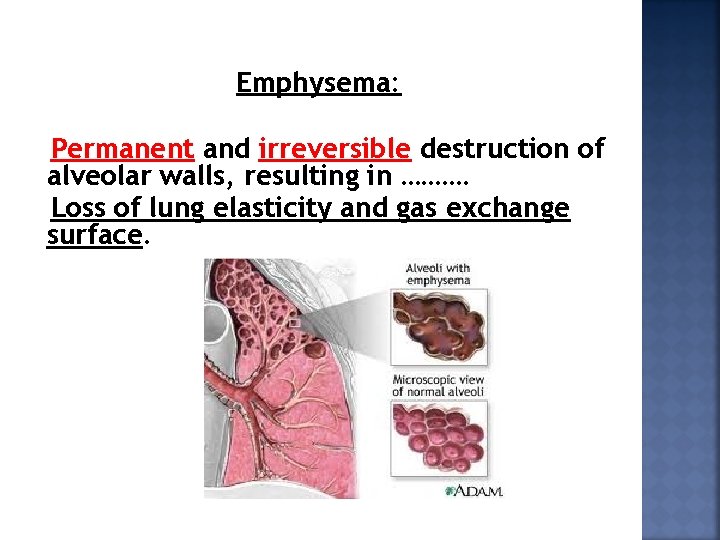 Emphysema: Permanent and irreversible destruction of alveolar walls, resulting in ………. Loss of lung