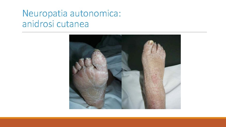 Neuropatia autonomica: anidrosi cutanea 