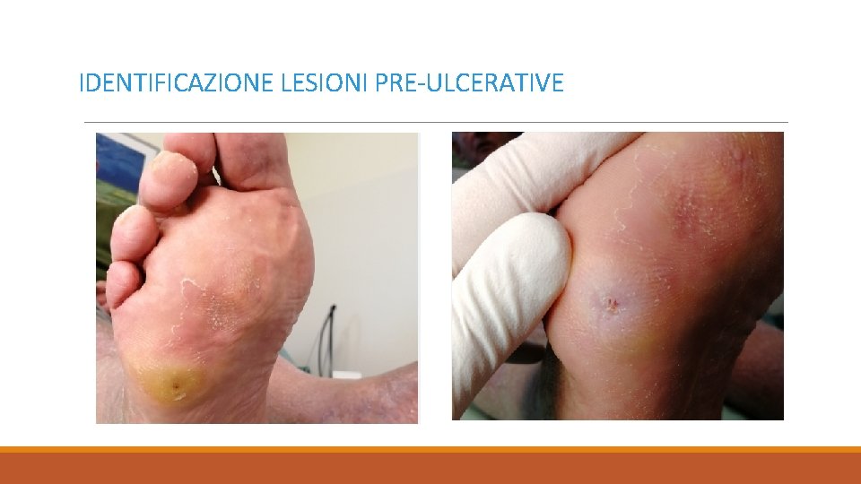 IDENTIFICAZIONE LESIONI PRE-ULCERATIVE 