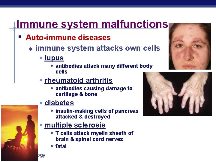 Immune system malfunctions § Auto-immune diseases u immune system attacks own cells § lupus