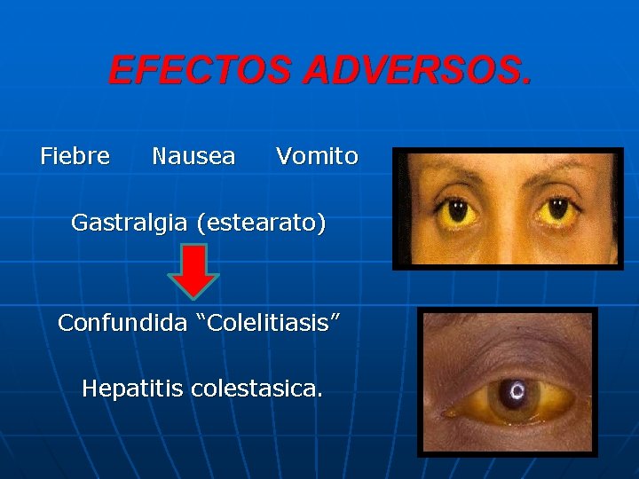 EFECTOS ADVERSOS. Fiebre Nausea Vomito Gastralgia (estearato) Confundida “Colelitiasis” Hepatitis colestasica. 