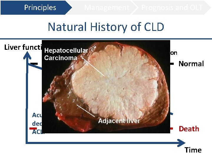 Principles Management Prognosis and OLT Natural History of CLD Liver function Treatment Transplantation Normal