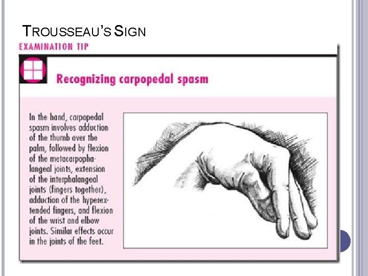 TROUSSEAU’S SIGN 