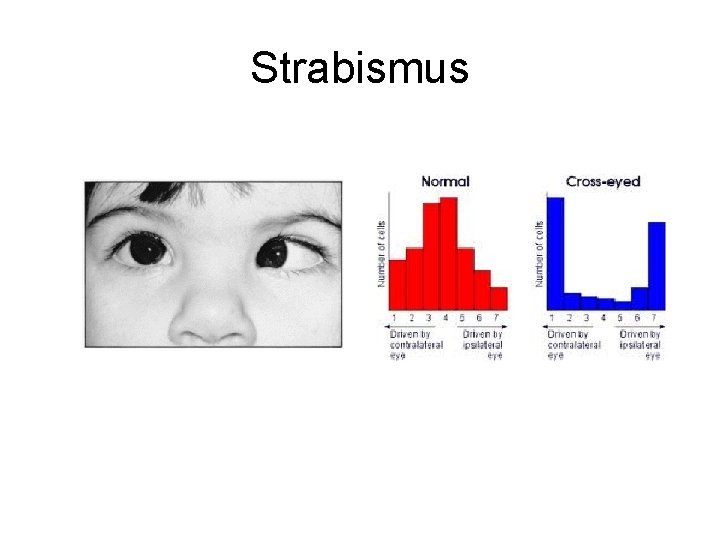 Strabismus 