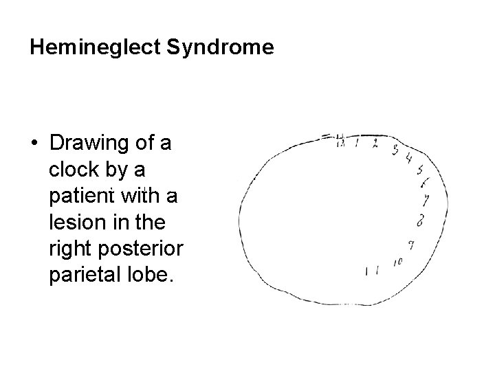 Hemineglect Syndrome • Drawing of a clock by a means that if you want