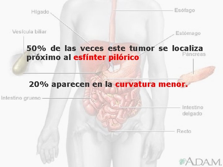 50% de las veces este tumor se localiza próximo al esfínter pilórico 20% aparecen