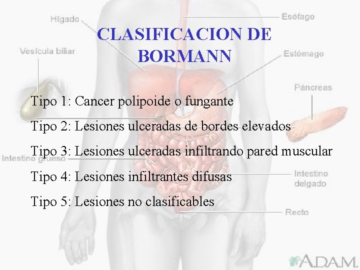 CLASIFICACION DE BORMANN Tipo 1: Cancer polipoide o fungante Tipo 2: Lesiones ulceradas de