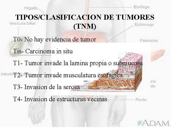 TIPOS/CLASIFICACION DE TUMORES (TNM) T 0 - No hay evidencia de tumor Tis- Carcinoma