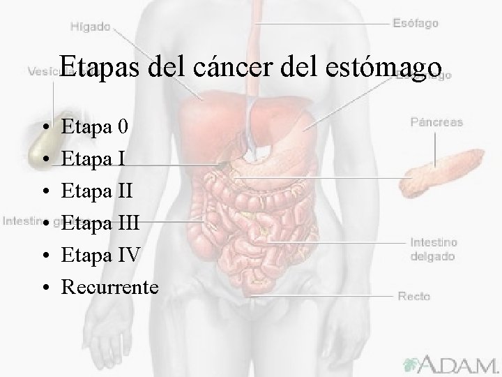 Etapas del cáncer del estómago • • • Etapa 0 Etapa III Etapa IV