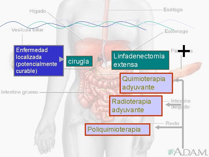 cirugía Linfadenectomìa extensa Quimioterapia adyuvante Radioterapia adyuvante Poliquimioterapia + Enfermedad localizada (potencialmente curable) 