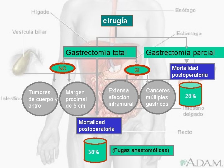 cirugía Gastrectomía total NO Tumores de cuerpo y antro Gastrectomía parcial Mortalidad postoperatoria SI