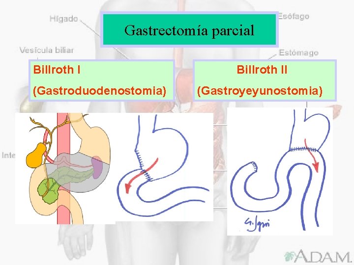 Gastrectomía parcial Billroth I (Gastroduodenostomia) Billroth II (Gastroyeyunostomia) 