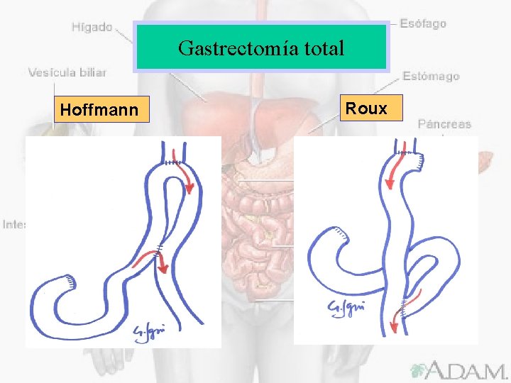 Gastrectomía total Hoffmann Roux 