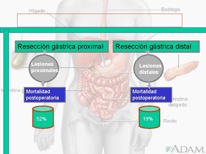 Resecciòn gástrica proximal Lesiones proximales Resecciòn gástrica distal Lesiones proximales dístales Mortalidad postoperatoria 52%