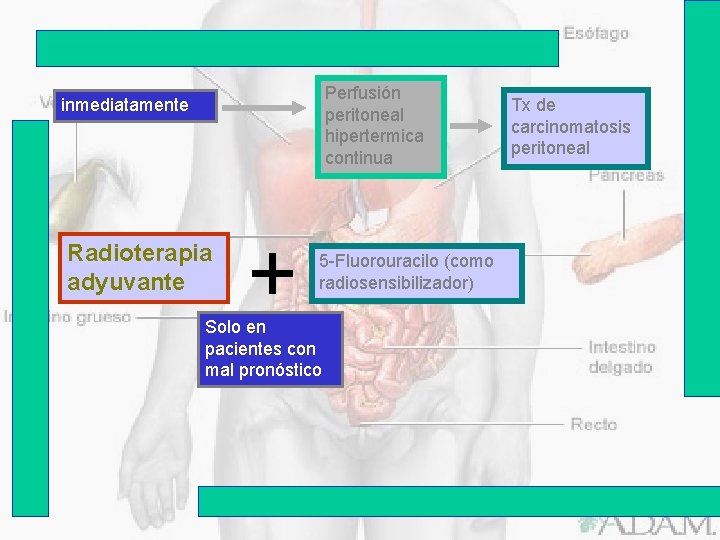 Perfusión peritoneal hipertermica continua inmediatamente Radioterapia adyuvante + 5 -Fluorouracilo (como radiosensibilizador) Solo en