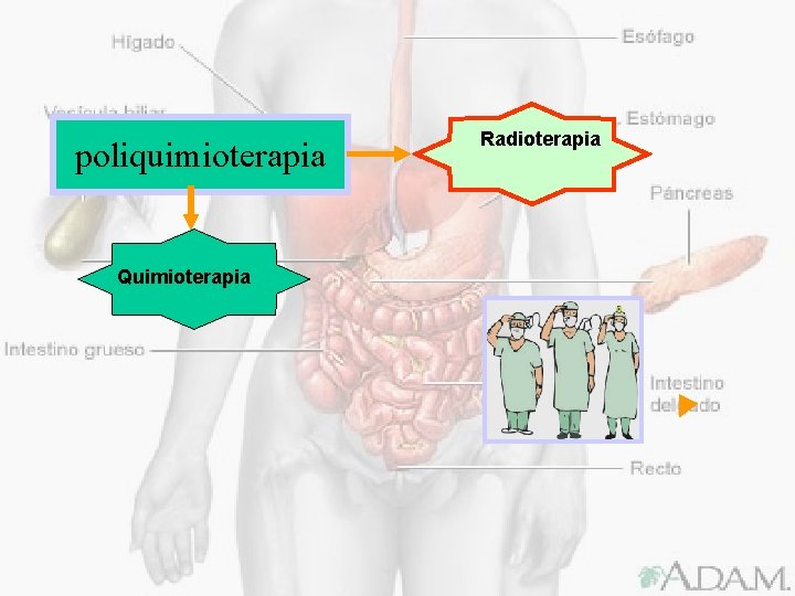 poliquimioterapia Quimioterapia Radioterapia 