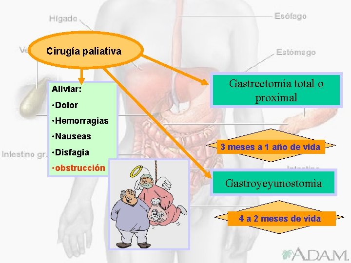 Cirugía paliativa Aliviar: • Dolor Gastrectomía total o proximal • Hemorragias • Nauseas •