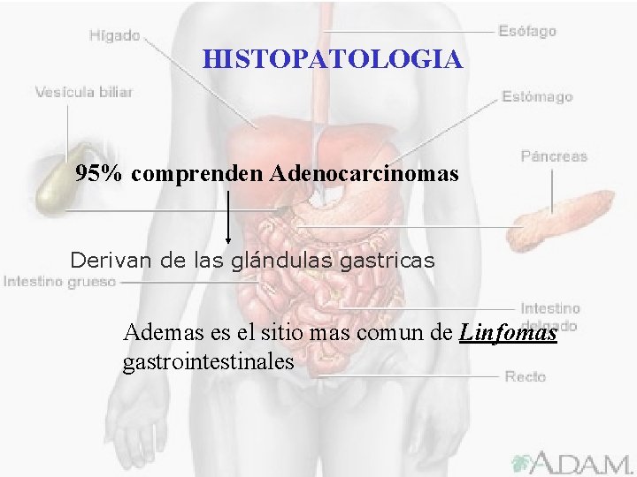 HISTOPATOLOGIA 95% comprenden Adenocarcinomas Derivan de las glándulas gastricas Ademas es el sitio mas
