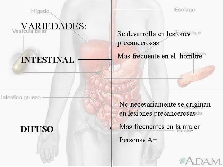 VARIEDADES: INTESTINAL Se desarrolla en lesiones precancerosas Mas frecuente en el hombre No necesariamente