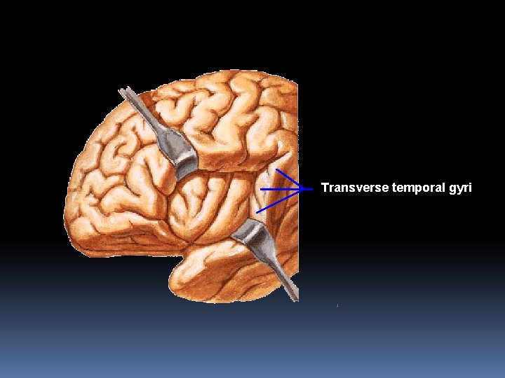 Transverse temporal gyri 