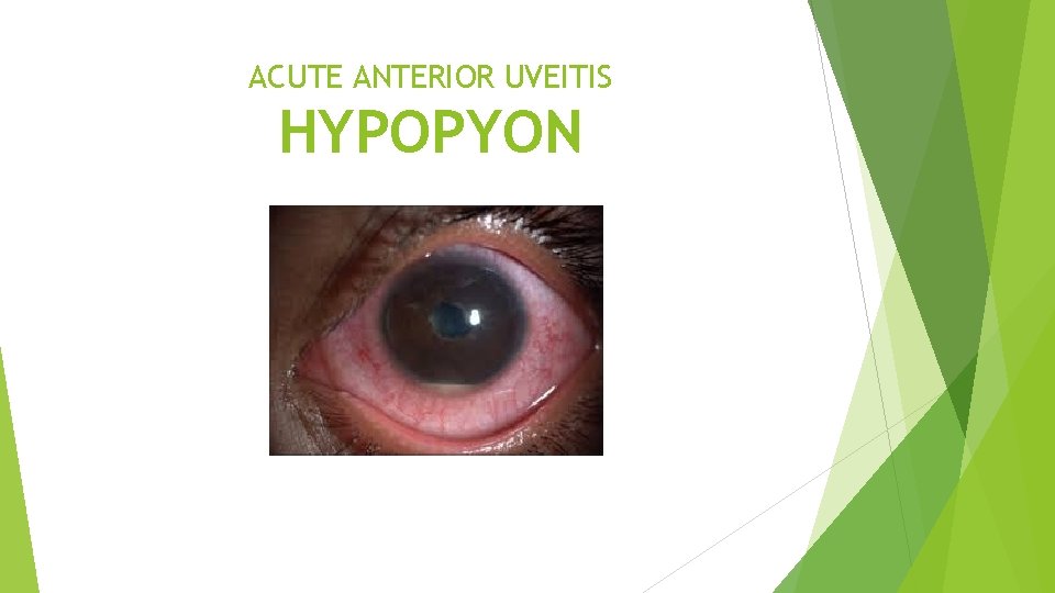 ACUTE ANTERIOR UVEITIS HYPOPYON 