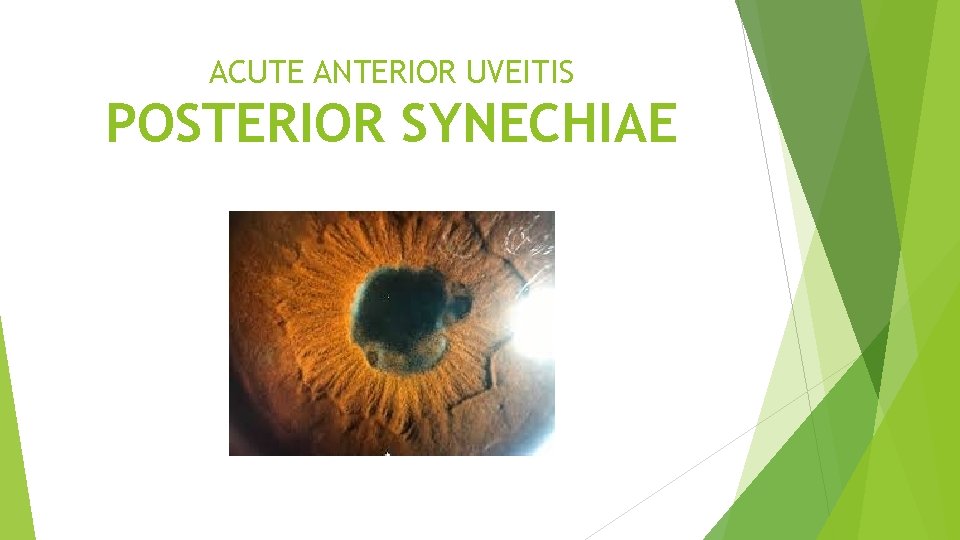 ACUTE ANTERIOR UVEITIS POSTERIOR SYNECHIAE 
