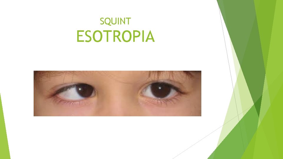 SQUINT ESOTROPIA 