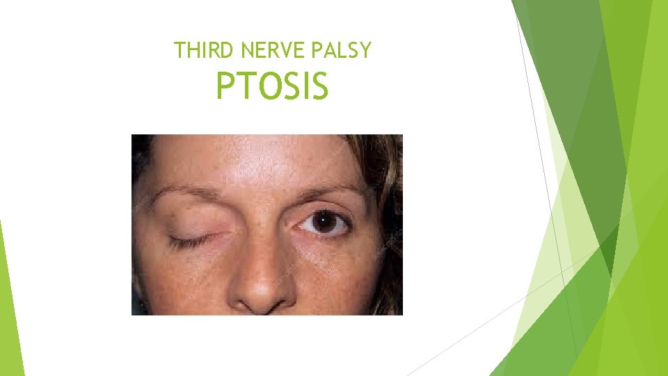 THIRD NERVE PALSY PTOSIS 