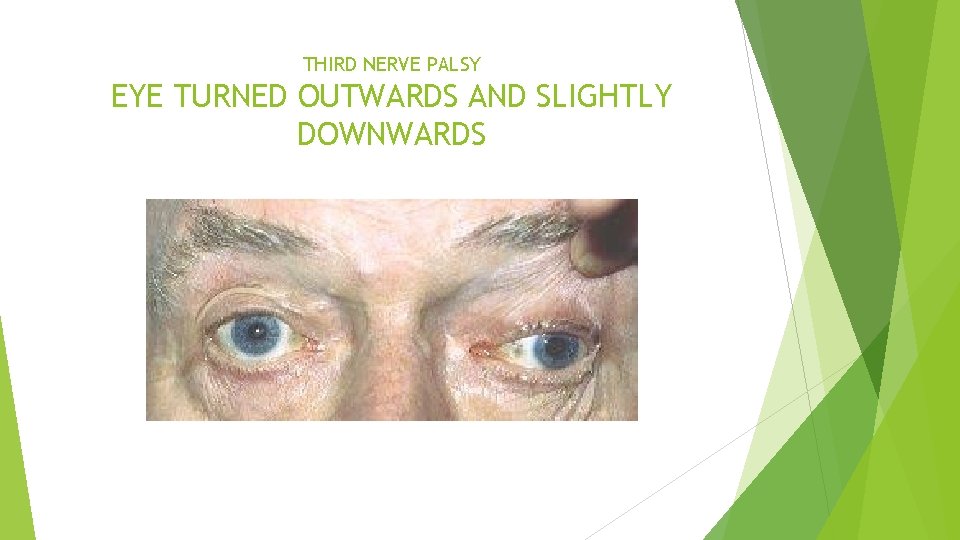 THIRD NERVE PALSY EYE TURNED OUTWARDS AND SLIGHTLY DOWNWARDS 