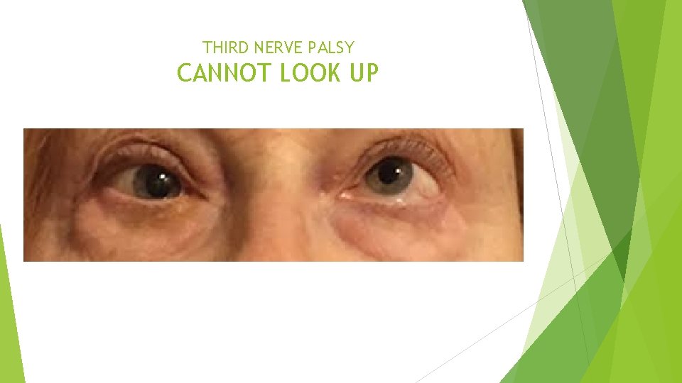 THIRD NERVE PALSY CANNOT LOOK UP 