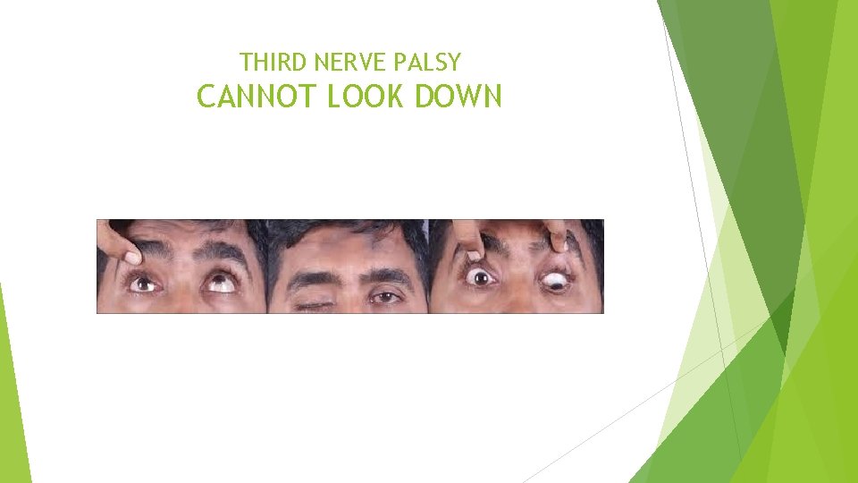 THIRD NERVE PALSY CANNOT LOOK DOWN 