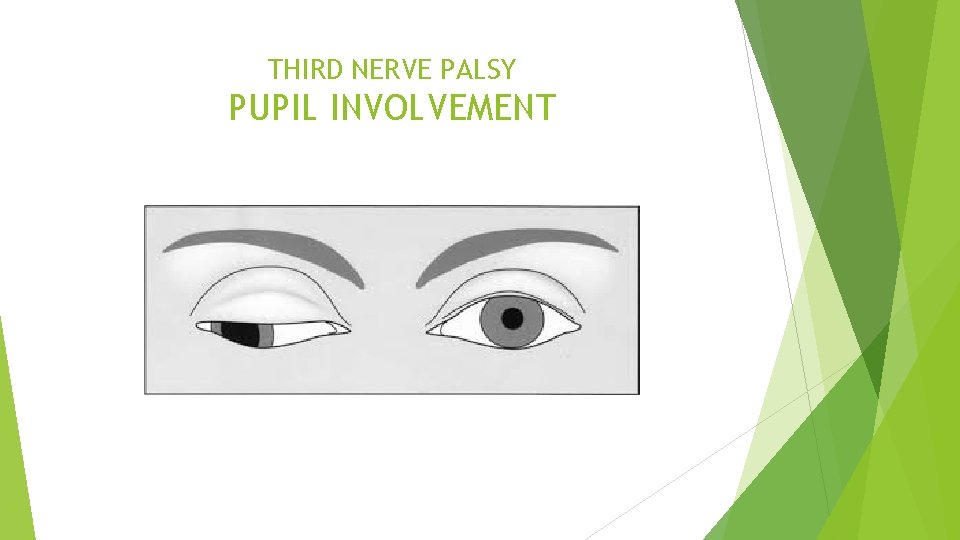 THIRD NERVE PALSY PUPIL INVOLVEMENT 