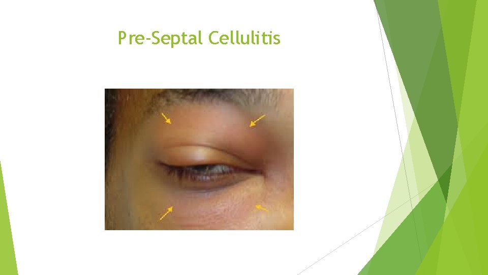 Pre-Septal Cellulitis 