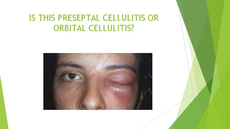 IS THIS PRESEPTAL CELLULITIS OR ORBITAL CELLULITIS? 