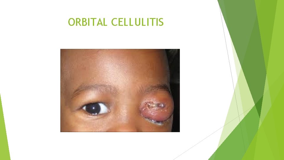 ORBITAL CELLULITIS 
