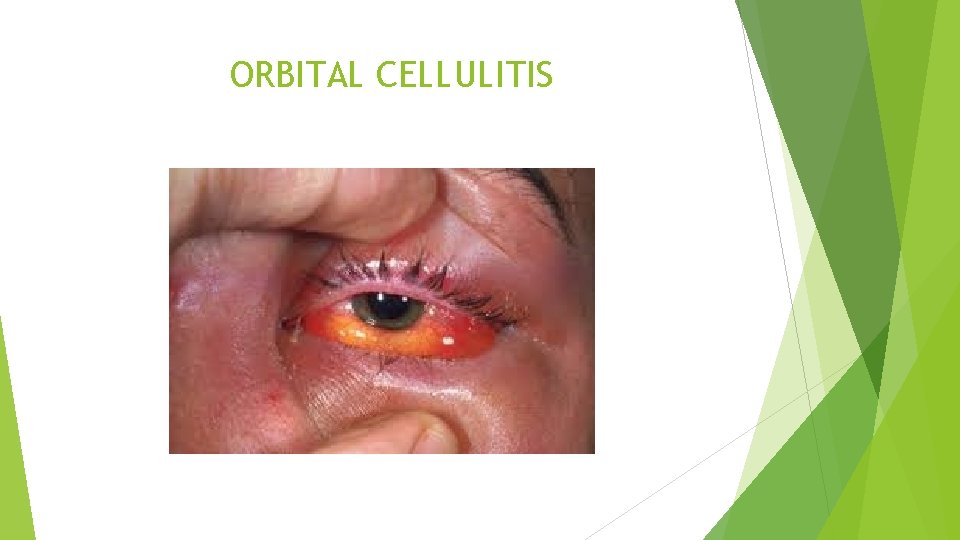ORBITAL CELLULITIS 