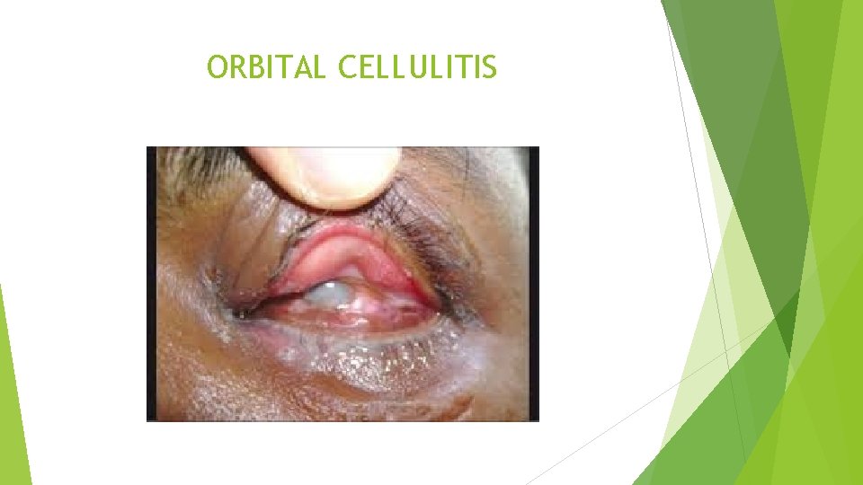 ORBITAL CELLULITIS 