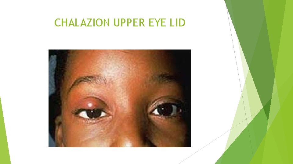 CHALAZION UPPER EYE LID 