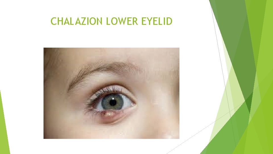 CHALAZION LOWER EYELID 