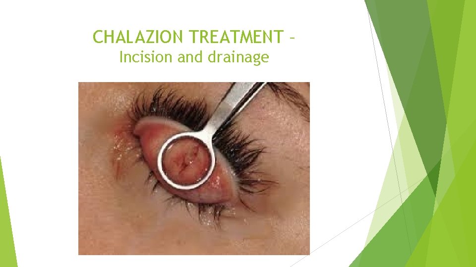 CHALAZION TREATMENT – Incision and drainage 
