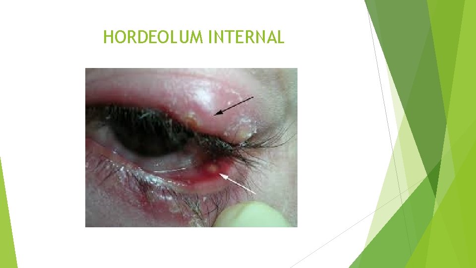 HORDEOLUM INTERNAL 