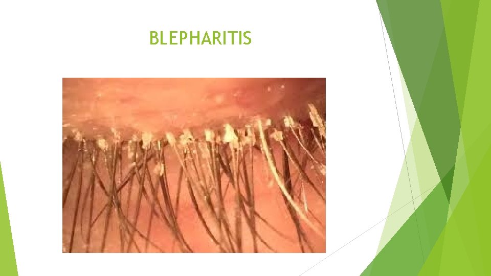 BLEPHARITIS 