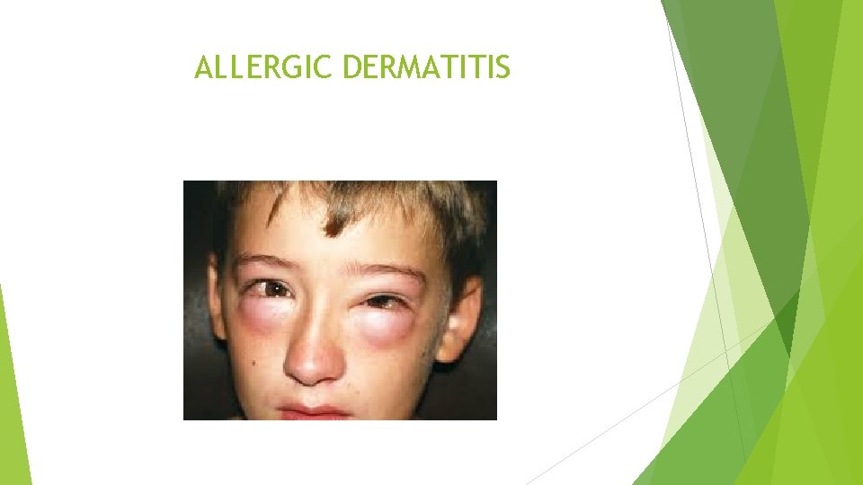 ALLERGIC DERMATITIS 