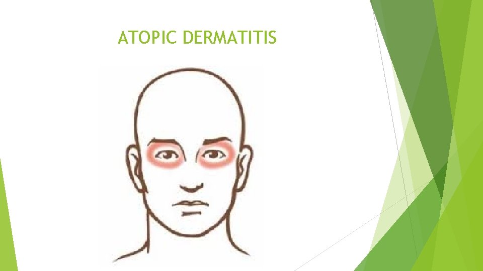 ATOPIC DERMATITIS 