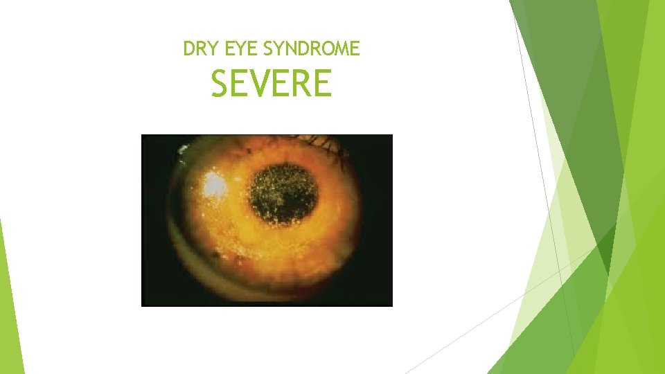 DRY EYE SYNDROME SEVERE 
