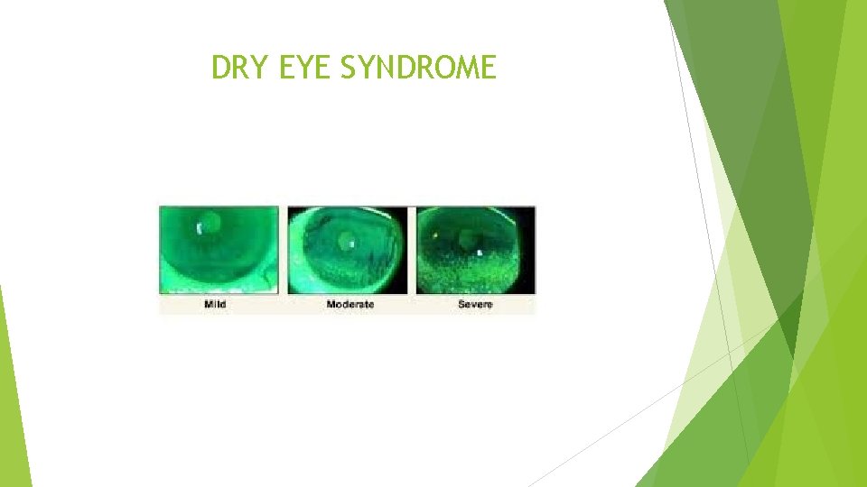 DRY EYE SYNDROME 