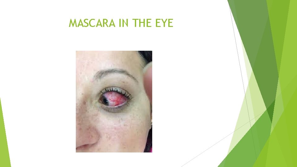 MASCARA IN THE EYE 