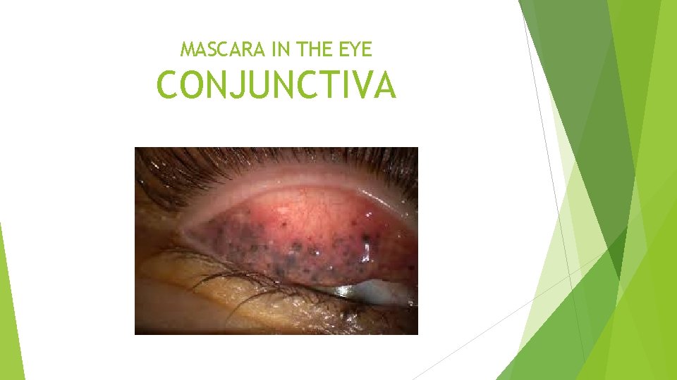 MASCARA IN THE EYE CONJUNCTIVA 