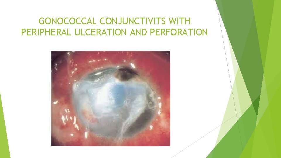 GONOCOCCAL CONJUNCTIVITS WITH PERIPHERAL ULCERATION AND PERFORATION 